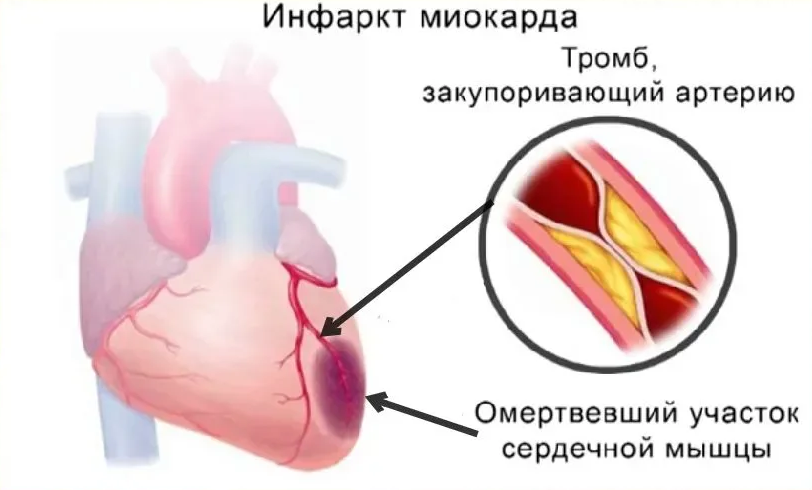 infarkt-miokarda[1].png