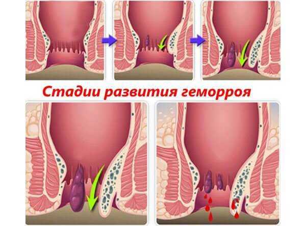 Стадии гемороя