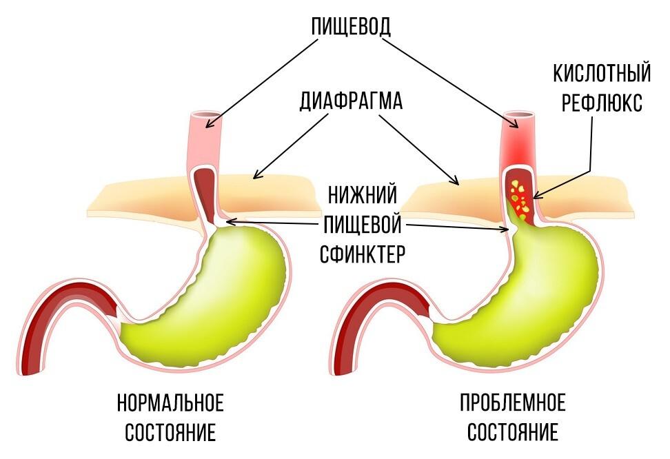 кислотный рефлюкс.jpg