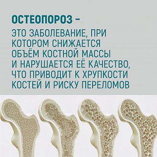 Остеопороз: "молчаливая болезнь" костей после 50 лет