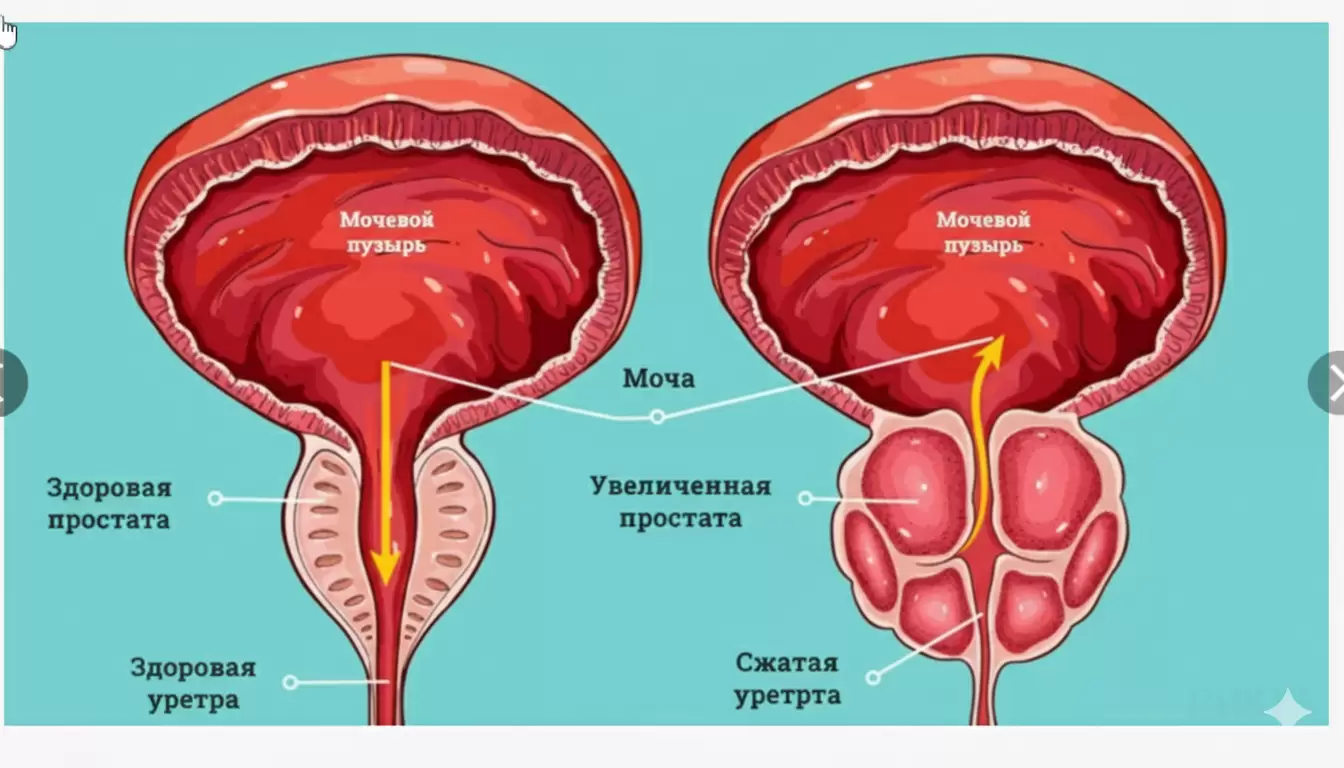 ДГПЖ и рак простаты: в чем разница в симптомах, диагностике и тактике наблюдения