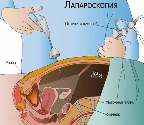 Киста яичника: симптомы и лечение. Операция по удалению кисты яичника