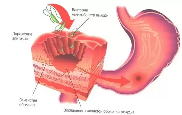 Бульбит: симптомы, лечение, диета