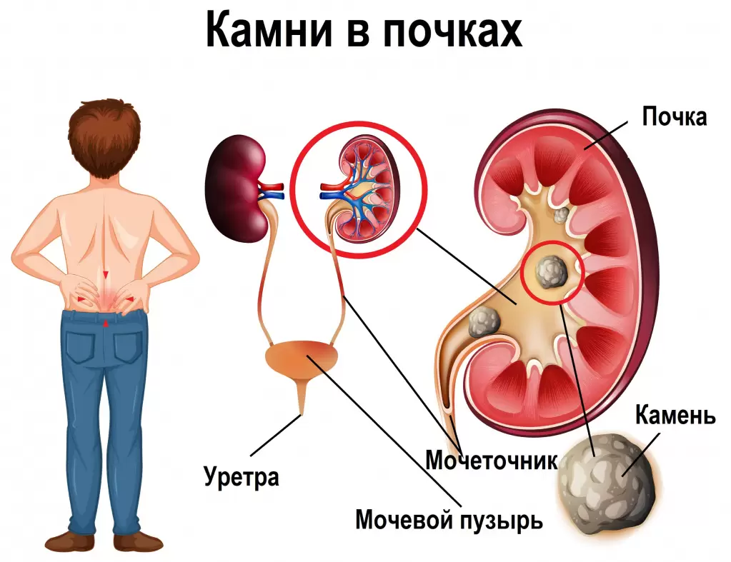 Мочекаменная болезнь. Симптомы, причины, лечение.