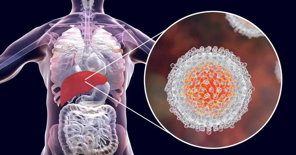 Вирусный гепатит С: причины, диагностика, симптомы и лечение