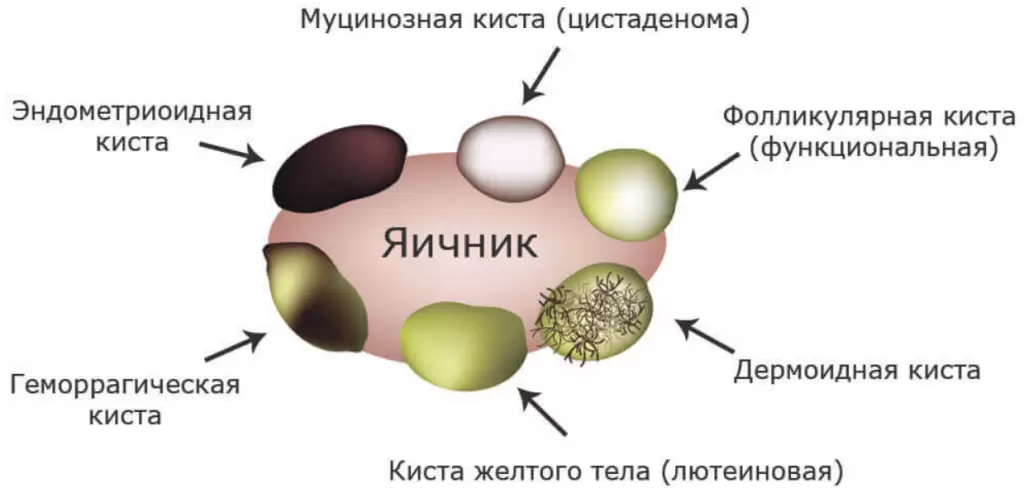 Киста Гартнерова хода, киста влагалища