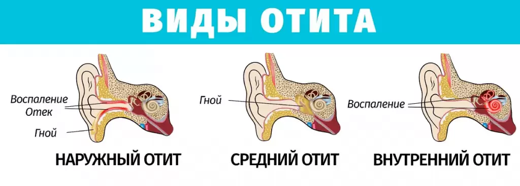 Отит: катаральный, экссудативный, адгезивный, хронический