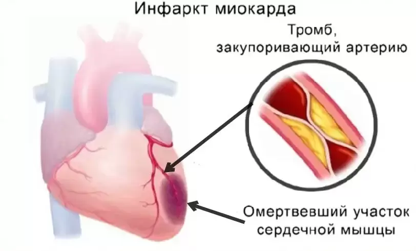 Можно ли вылечить ишемическую болезнь сердца?