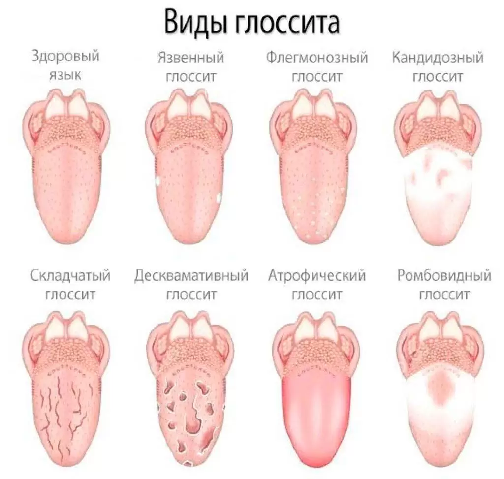 Что такое глоссит: что это, причины, симптомы и лечение