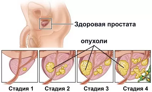 Аденома простаты у мужчин