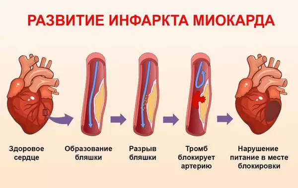 Инфаркт миокарда: причины, первая помощь, профилактика — МБУЗ Городская поликлиника 4 г. Краснодар