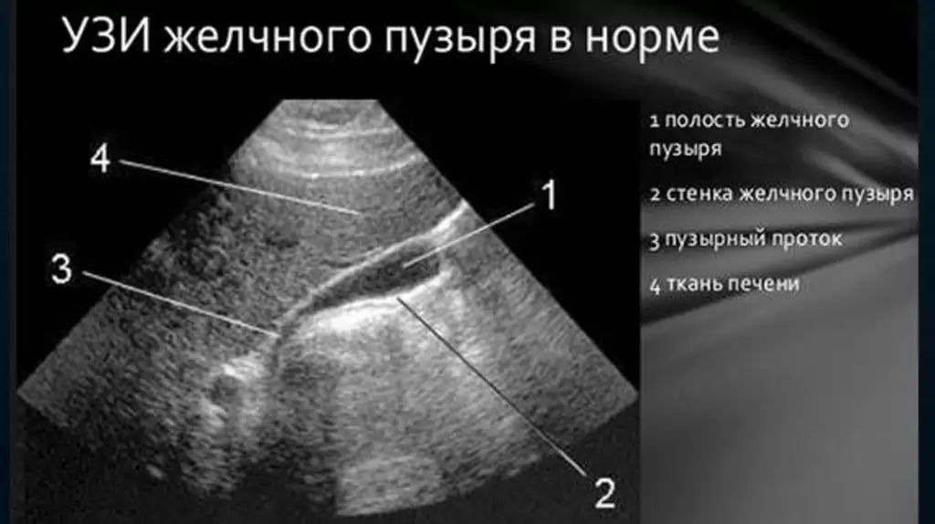 Закупорка желчных протоков. Что такое Закупорка желчных протоков?