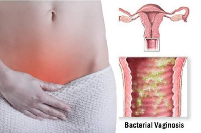 Бактериальный вагиноз: причины, симптомы, методы лечение и осложнения